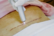 Dịch vụ Chiếu tia Plasma lạnh