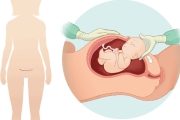 Mổ lấy thai và nguy cơ cho thai kỳ sau