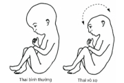 Thai vô sọ (Anencephaly)